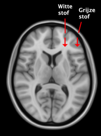 landen crisis Omringd Samenvatting MRI-onderzoek van de hersenen bij patiënten met de ziekte van  Parkinson - Parkinson Vereniging