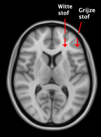 Samenvatting MRI-onderzoek van de patiënten met de ziekte van Parkinson - Parkinson Vereniging