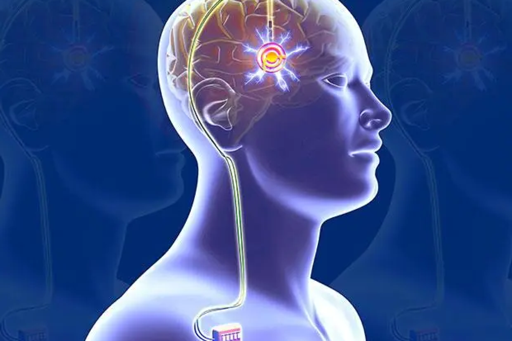 Deep Brain Stimulation