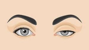 Tineke Witteveen_ptosis